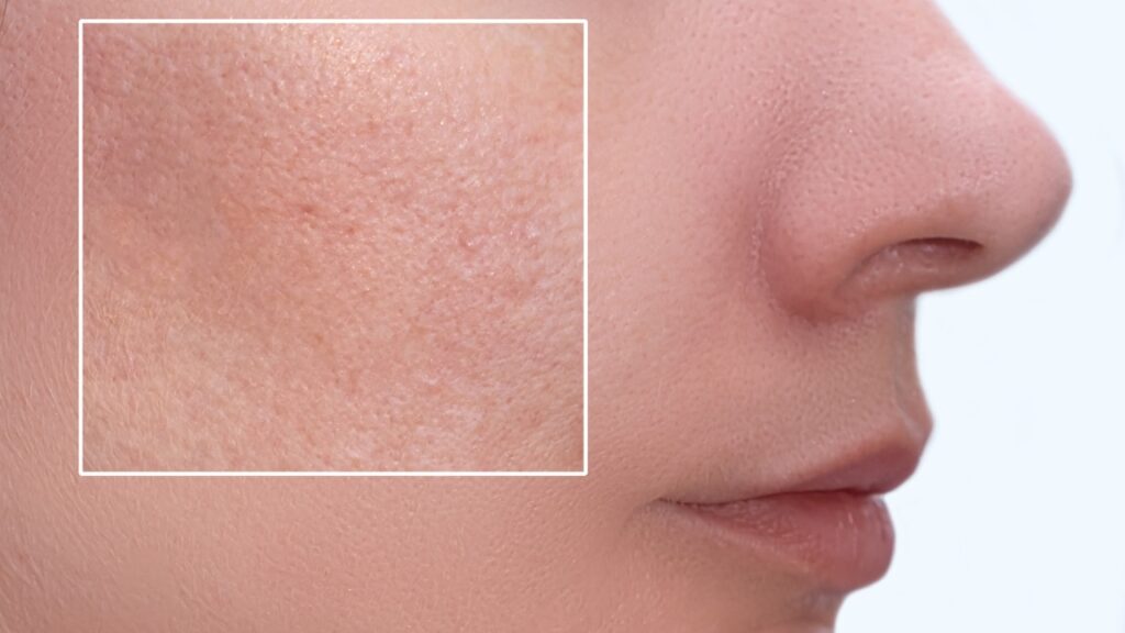 Pore-Clogging: Causes, Prevention & Skincare Tips